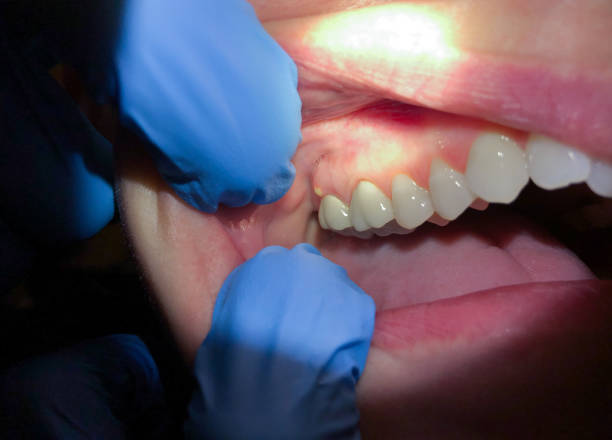 Emergency Dentist for Dental Implants