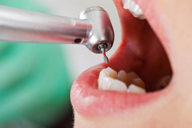 Best Emergency Dental Extractions in Lake St Louis, MO